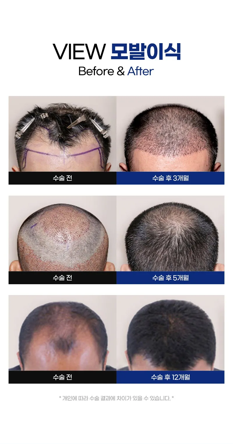 뷰성형외과 ❤뷰❤모발이식 이벤트, 시술 상세 이미지
