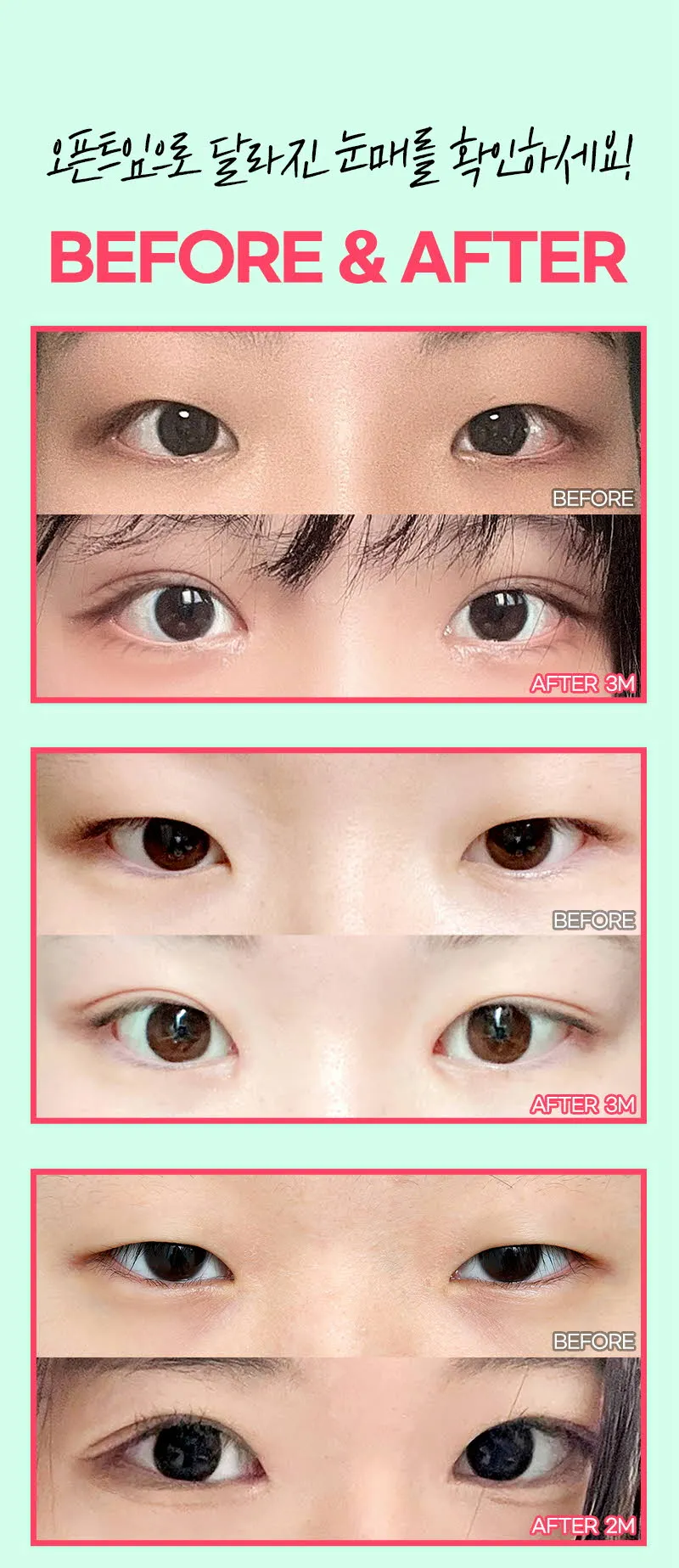 뷰성형외과 ❤️뷰❤️오픈 트임 이벤트, 시술 상세 이미지