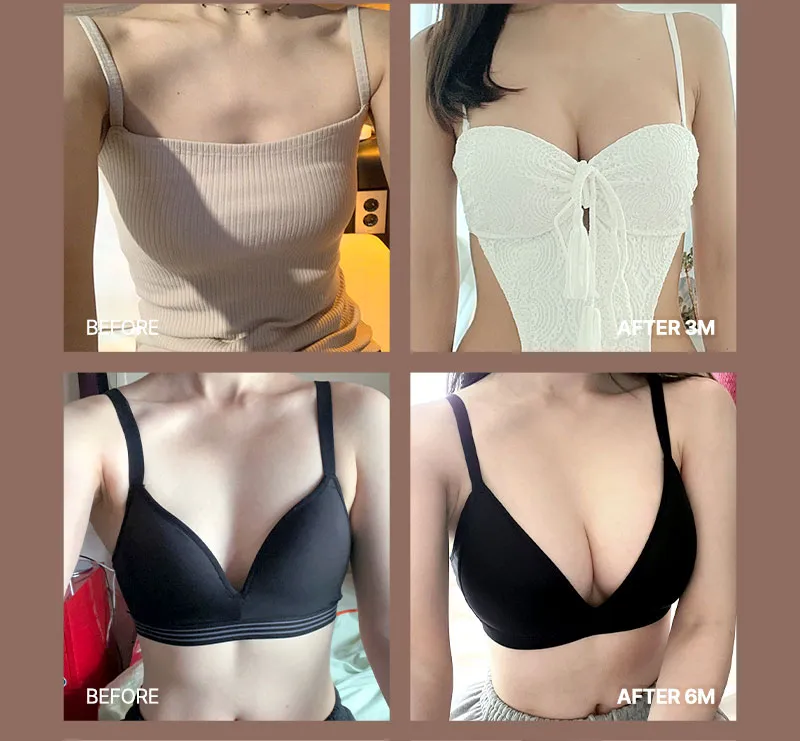 뷰성형외과 ❤뷰❤여의사 UIU 가슴성형 이벤트, 시술 상세 이미지