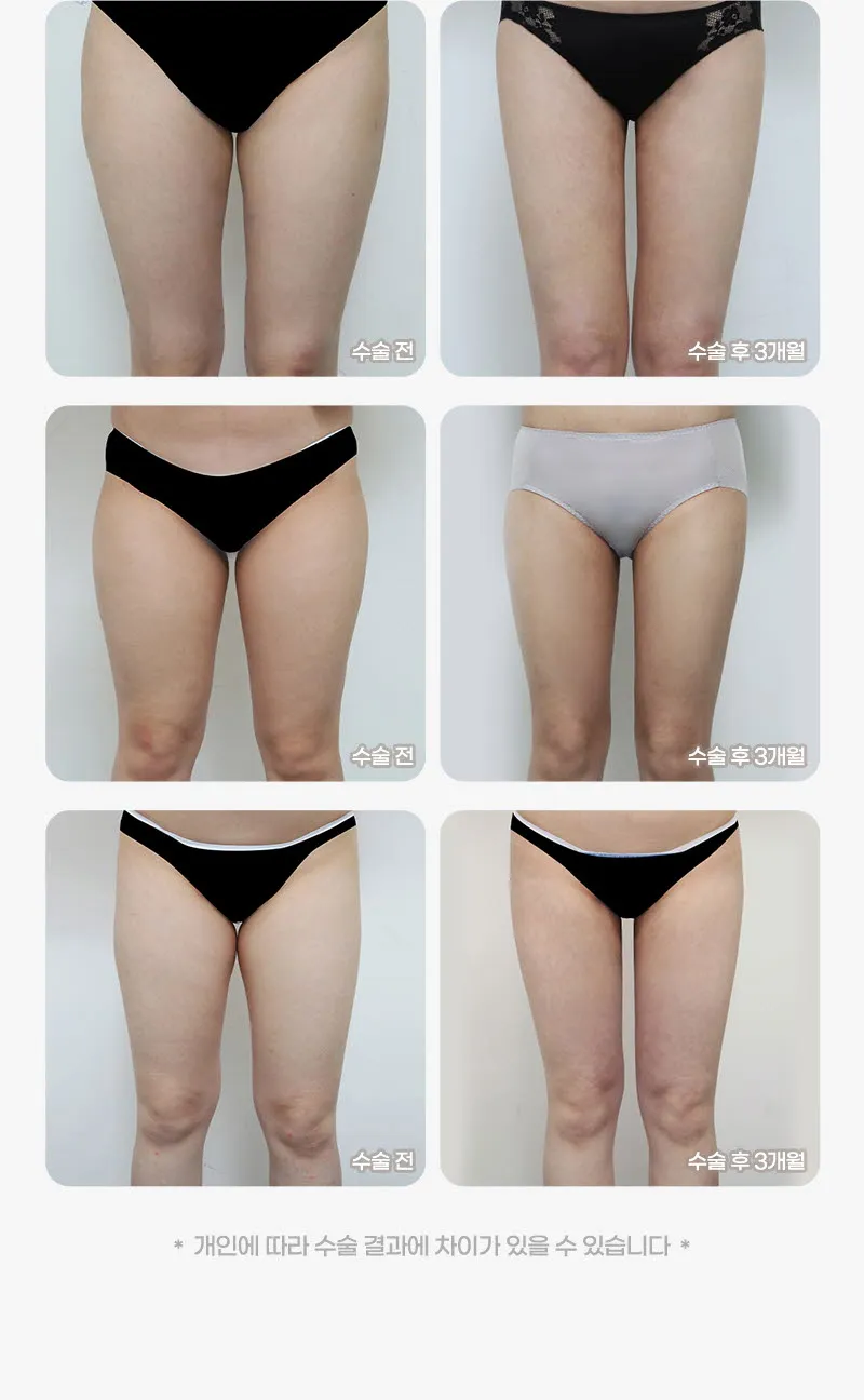 뷰성형외과 ❤️뷰❤️대용량 지방흡입 이벤트, 시술 상세 이미지