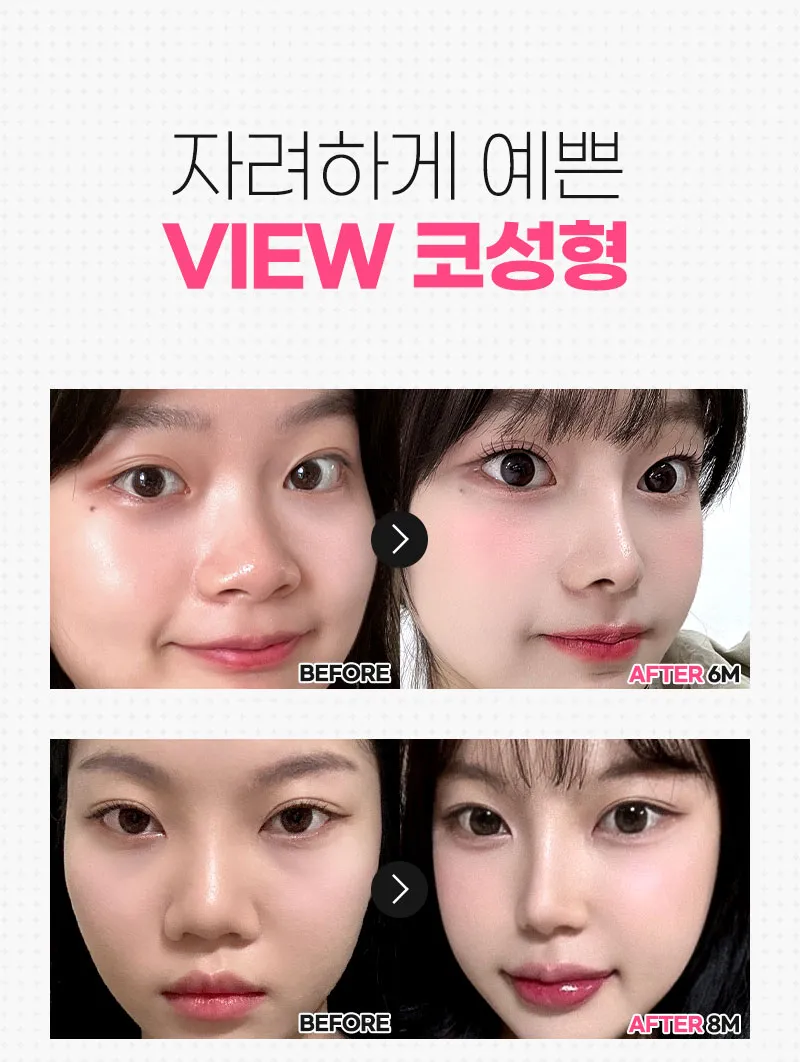 뷰성형외과 ❤️뷰❤️매부리코성형 이벤트, 시술 상세 이미지
