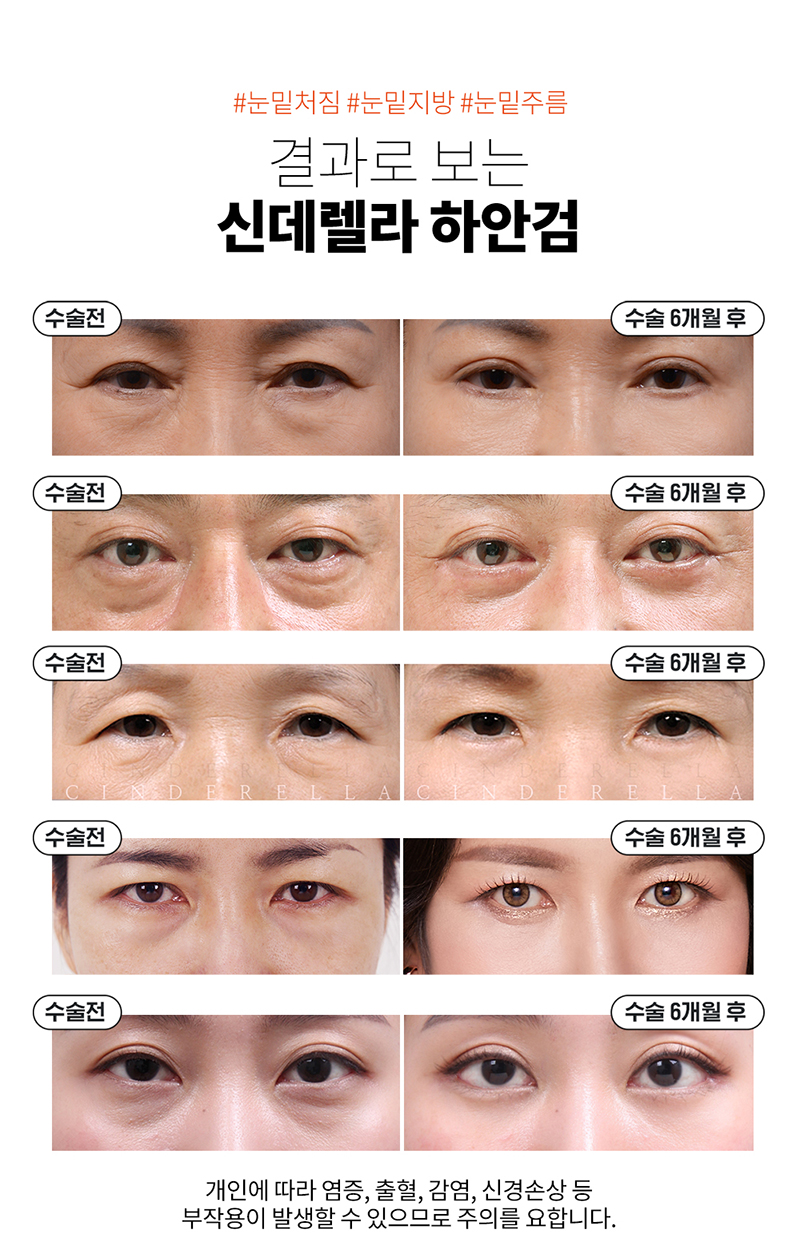 신데렐라성형외과의원 신데렐라 볼륨하안검🧡 이벤트, 시술 상세 이미지
