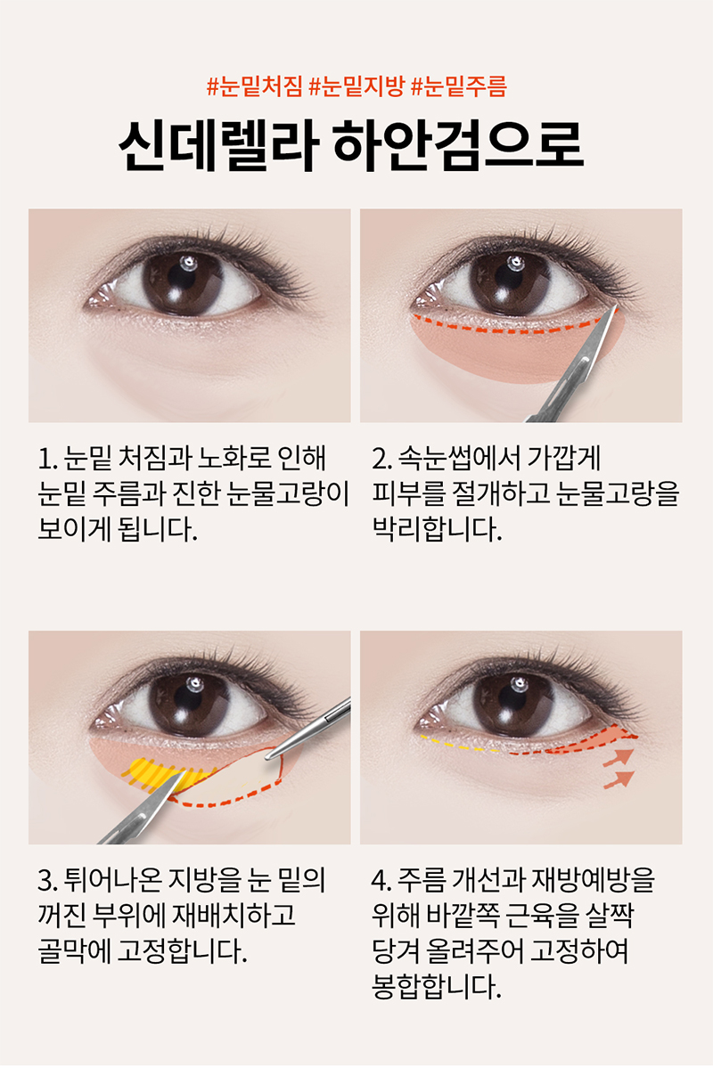 신데렐라성형외과의원 신데렐라 볼륨하안검🧡 이벤트, 시술 상세 이미지