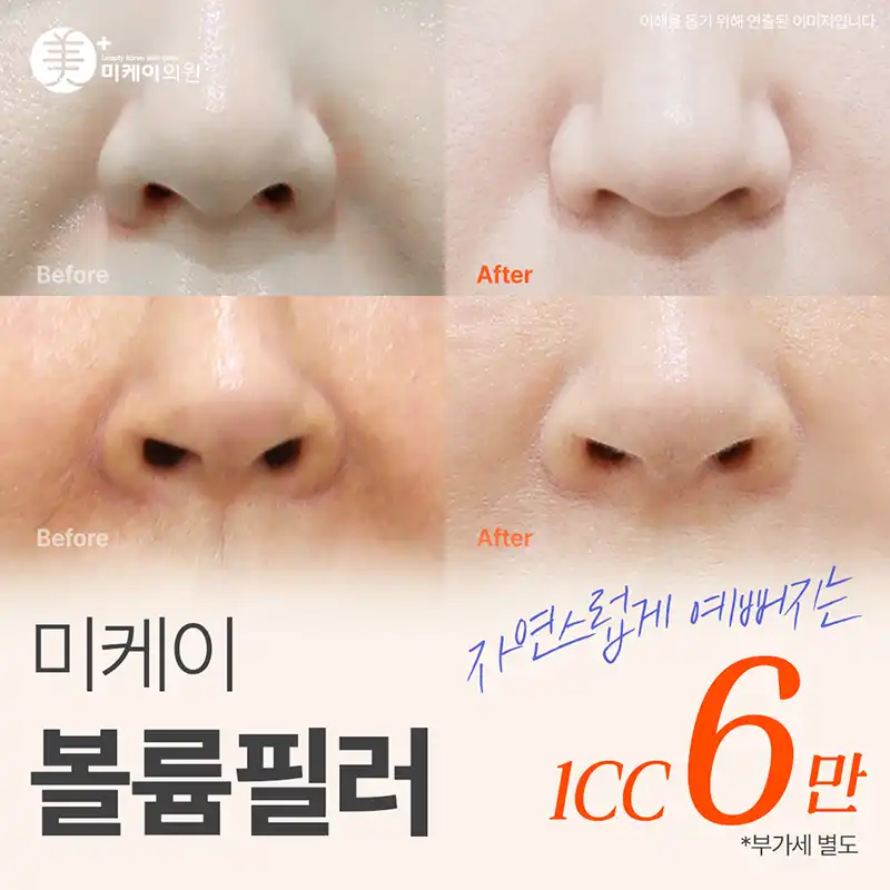 미케이 맞춤 필러_입술, 턱끝, 팔자