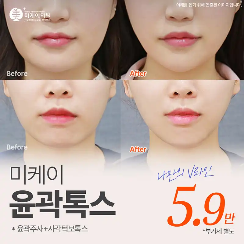 미케이 V라인 윤곽주사+사각턱보톡스