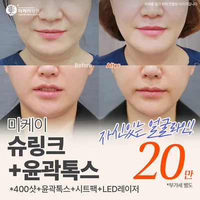 미케이 탄력 개선_슈링크+윤곽톡스 이벤트 썸네일 이미지