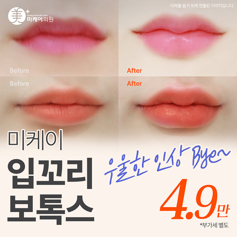 미케이 입꼬리 보톡스 이벤트 썸네일 이미지
