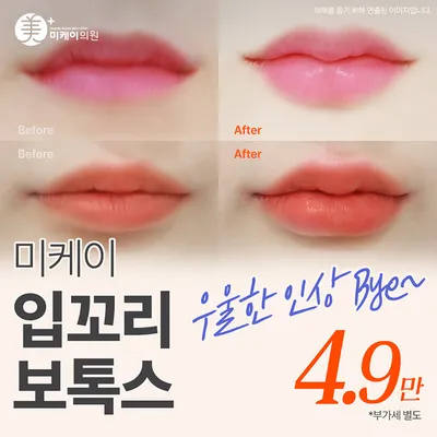 미케이 입꼬리 보톡스 이벤트 썸네일 이미지