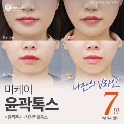 미케이 V라인 윤곽주사+사각턱보톡스 이벤트 썸네일 이미지