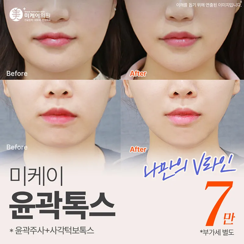 미케이 V라인 윤곽주사+사각턱보톡스