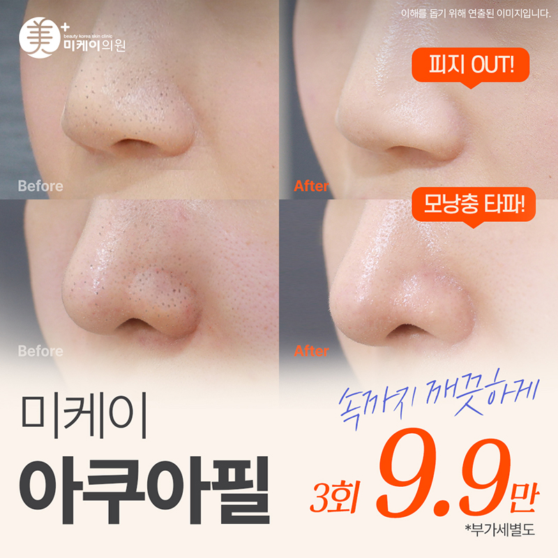 미케이 각질&모공 청소_아쿠아필 이벤트 썸네일 이미지