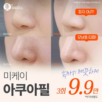 미케이 각질&모공 청소_아쿠아필 이벤트 썸네일 이미지