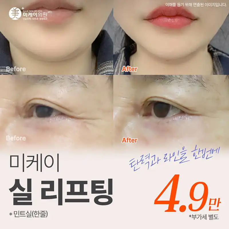 미케이 민트실 동안 리프팅_팔자,눈가