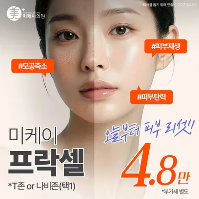 미케이 모공&여드름 흉터 개선_프락셀 이벤트 썸네일 이미지