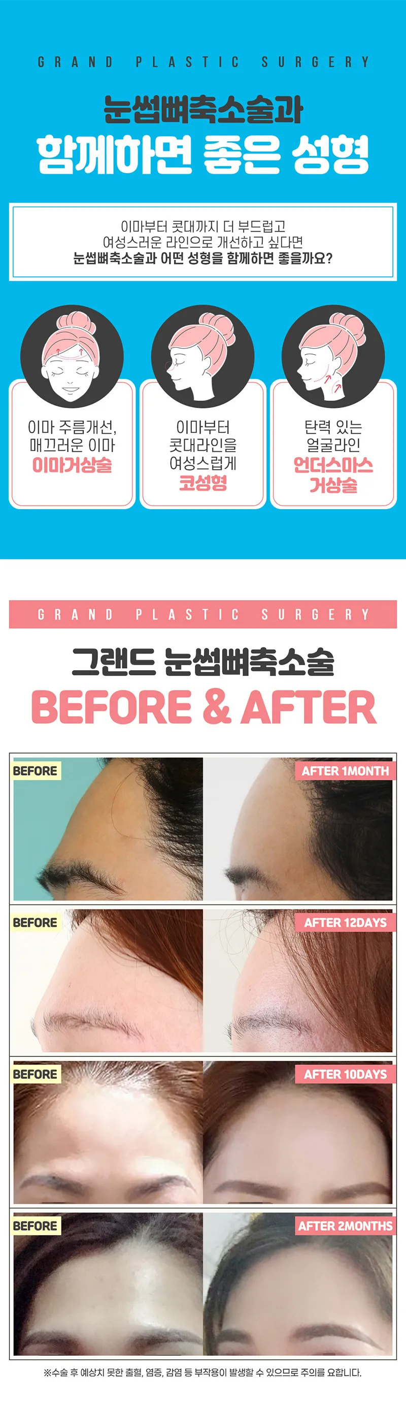 그랜드성형외과 부드러운 이마라인 눈썹뼈축소 이벤트, 시술 상세 이미지