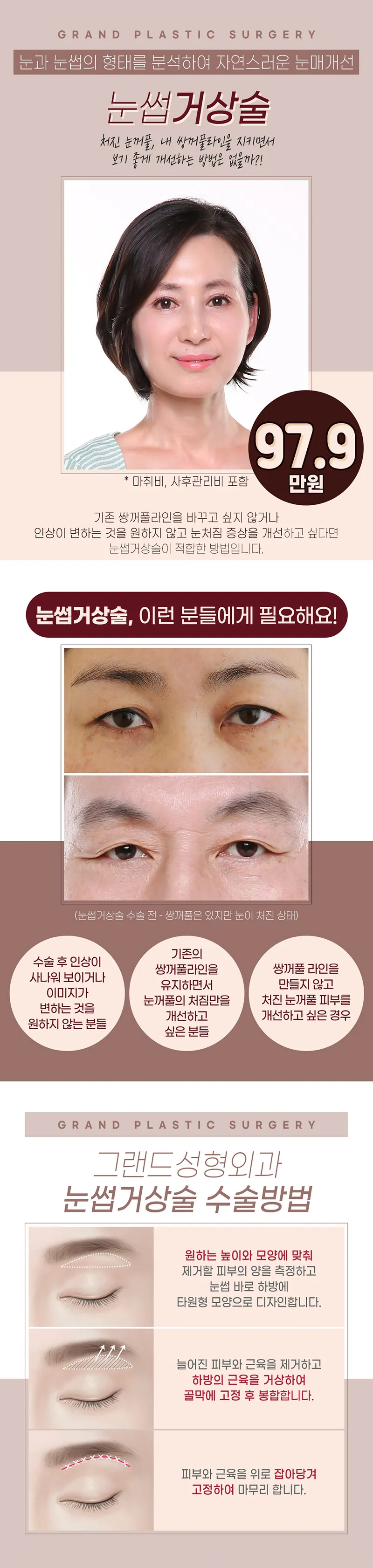 그랜드성형외과 눈썹거상술 처진 눈꺼풀 개선 이벤트, 시술 상세 이미지