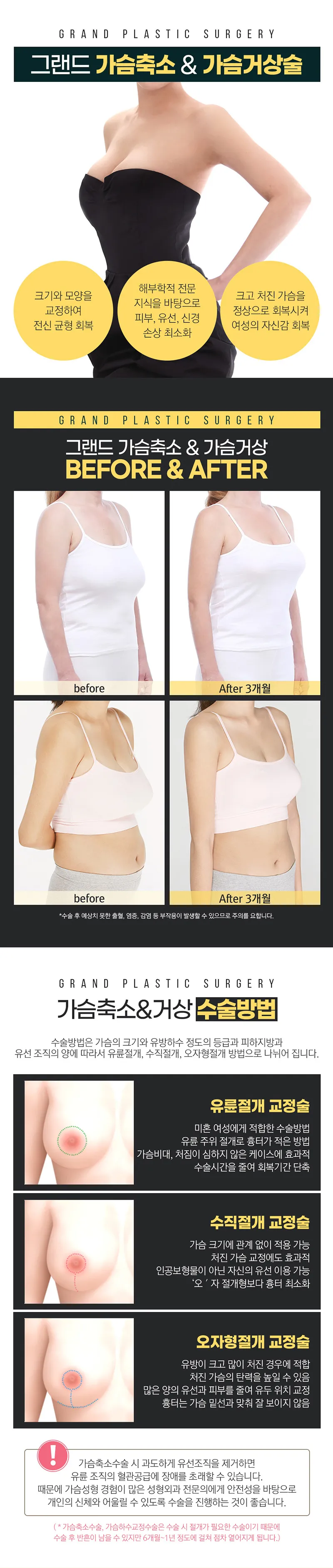 그랜드성형외과 그랜드 가슴축소&가슴거상술 이벤트, 시술 상세 이미지