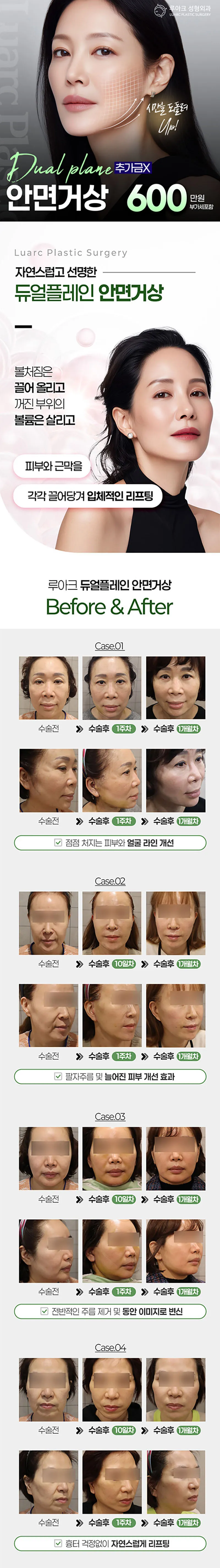 루아크성형외과 루아크 SMAS 듀얼플레인 풀안면거상 이벤트, 시술 상세 이미지