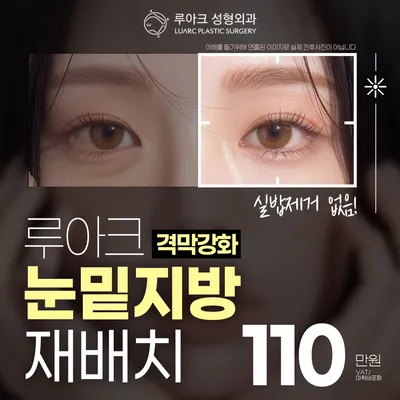 루아크 격막강화 눈밑지방재배치 이벤트 썸네일 이미지