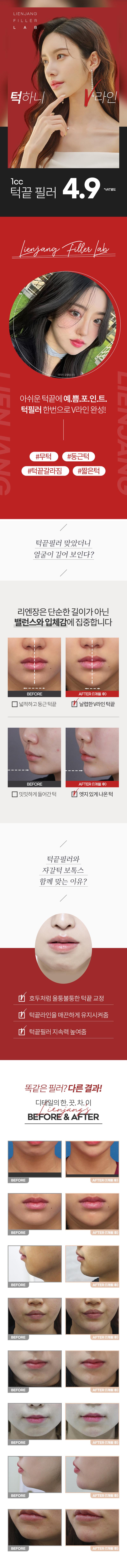 리엔장의원 잠실점 리엔장 잠실, 턱끝필러 이벤트, 시술 상세 이미지