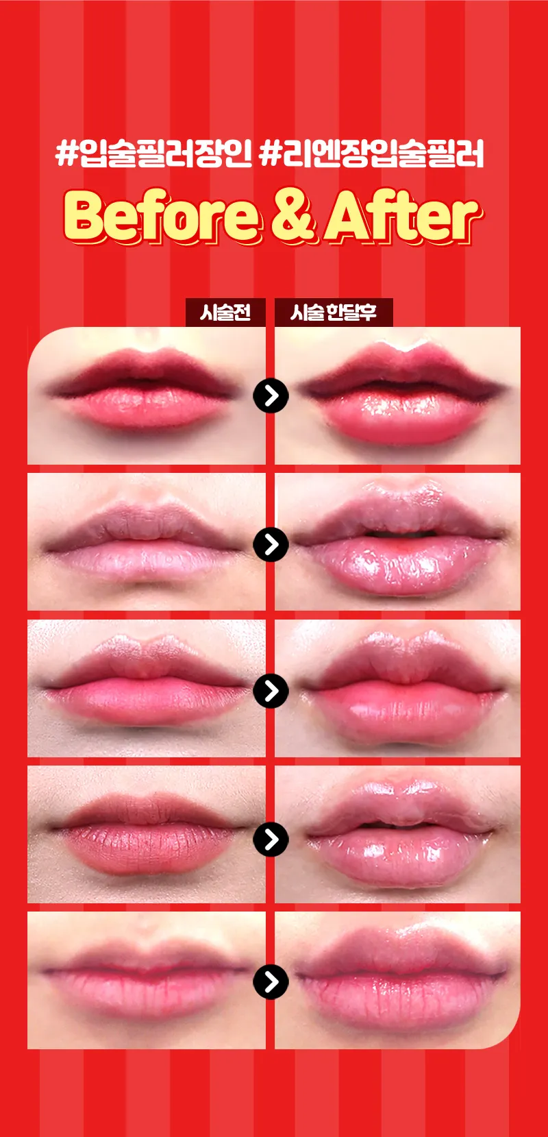리엔장의원 하남미사 하남 앵두라인 입술필러 이벤트, 시술 상세 이미지