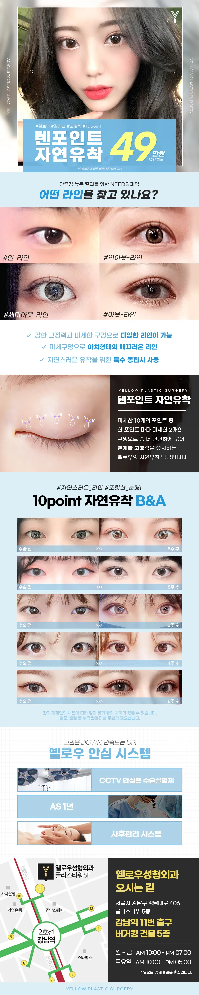 옐로우성형외과 💛옐로우 텐포인트 자연유착💛 이벤트, 시술 상세 이미지