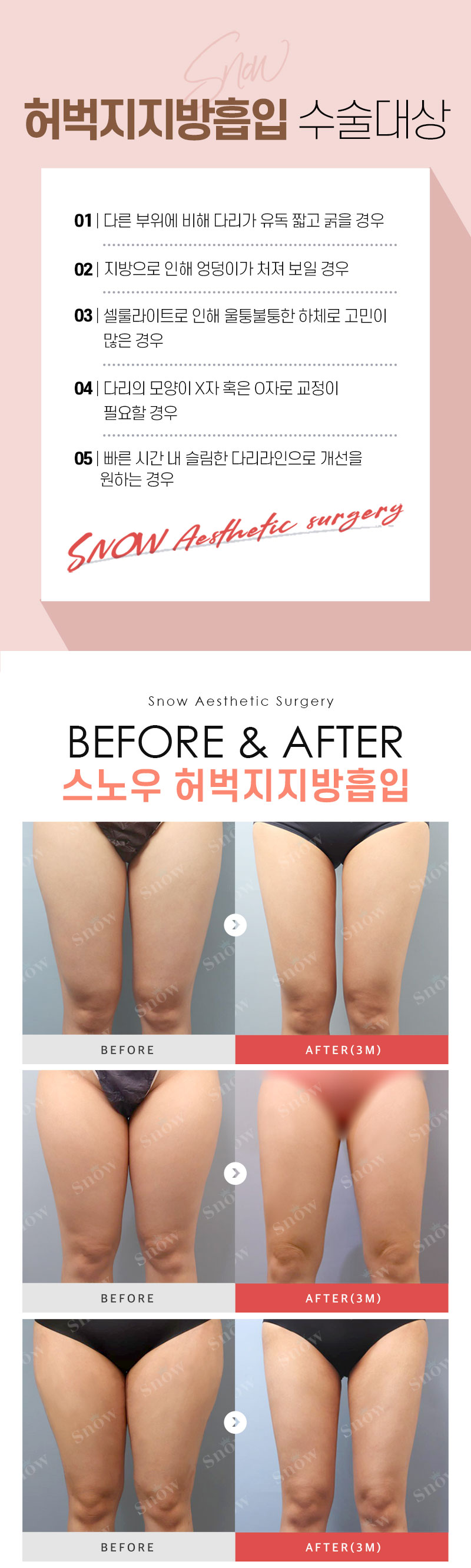 스노우의원 수험생 허벅지지방흡입 이벤트 이벤트, 시술 상세 이미지