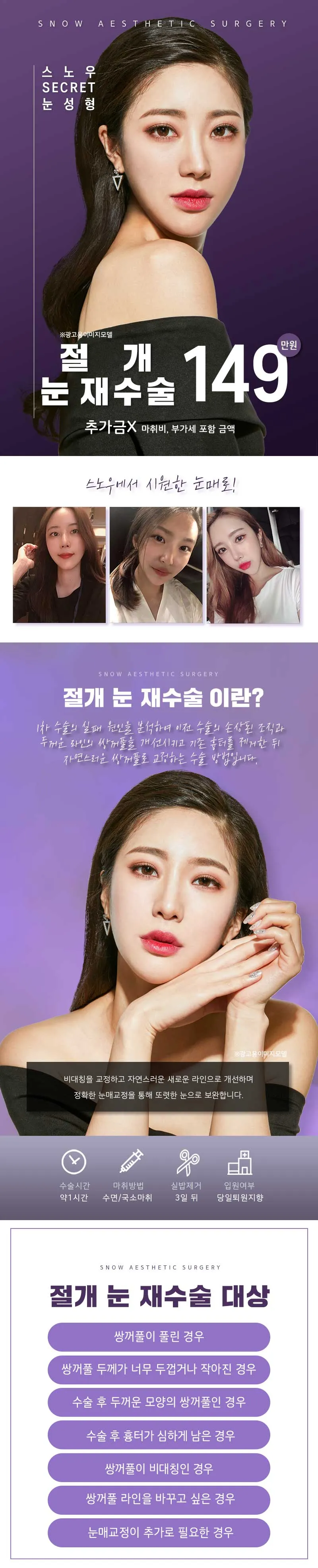 스노우의원 비밀눈성형 절개 눈재수술 이벤트, 시술 상세 이미지