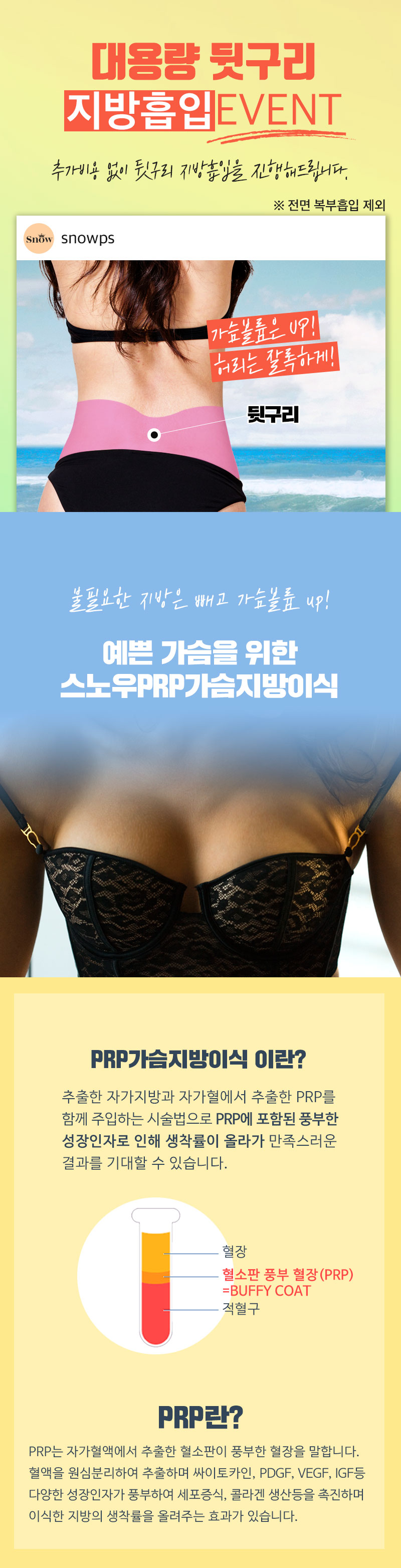 스노우의원 PRP 가슴지방이식 이벤트, 시술 상세 이미지