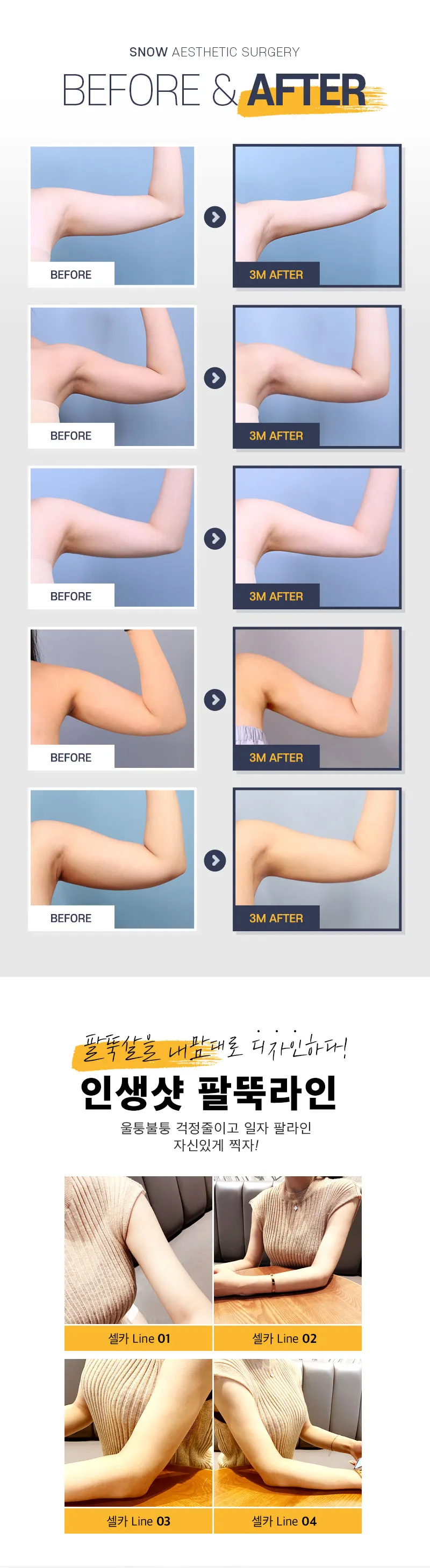 스노우의원 대용량 팔 지방흡입 이벤트, 시술 상세 이미지