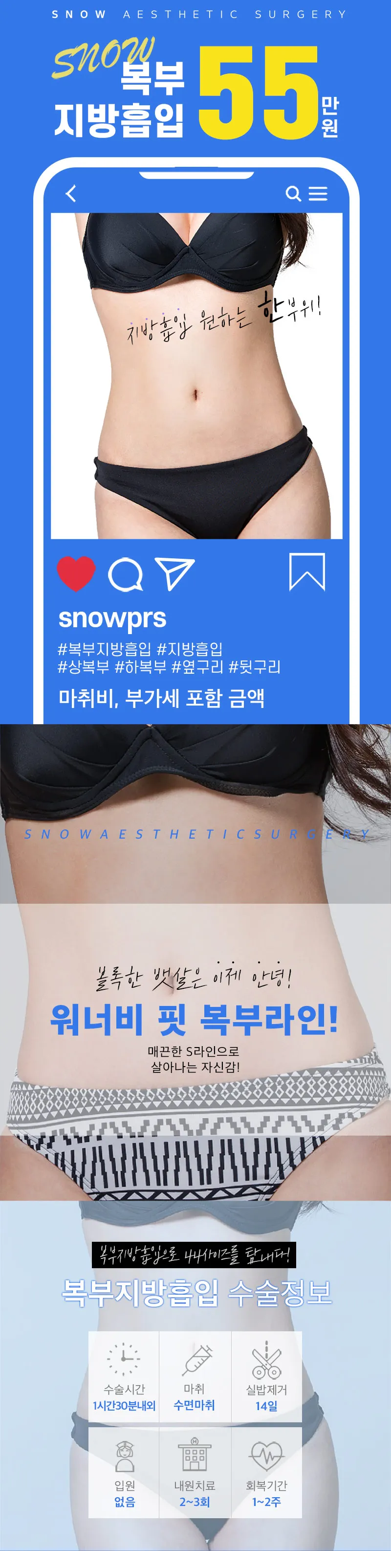 스노우의원 대용량 복부 지방흡입 이벤트, 시술 상세 이미지