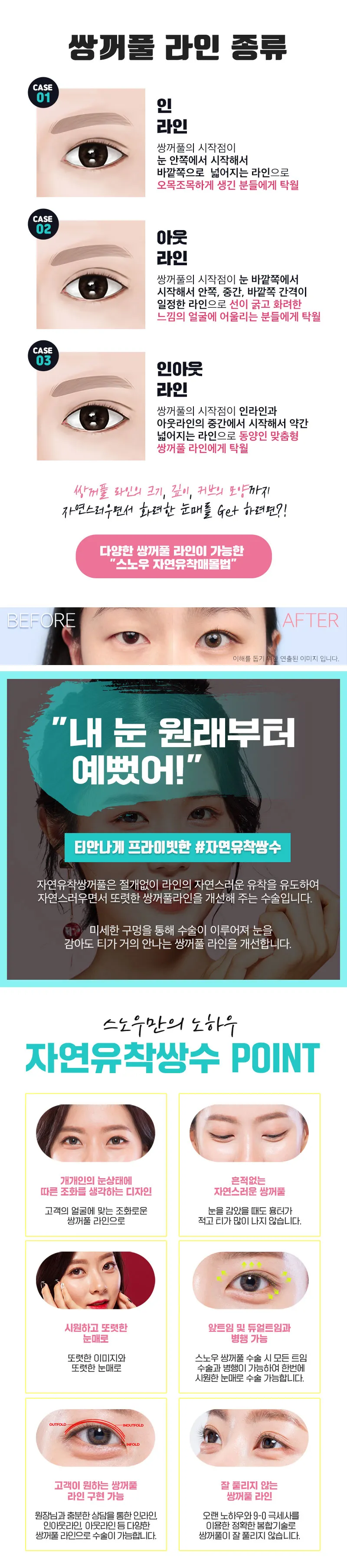 스노우의원 자연스러운 자연유착 쌍커풀 이벤트, 시술 상세 이미지