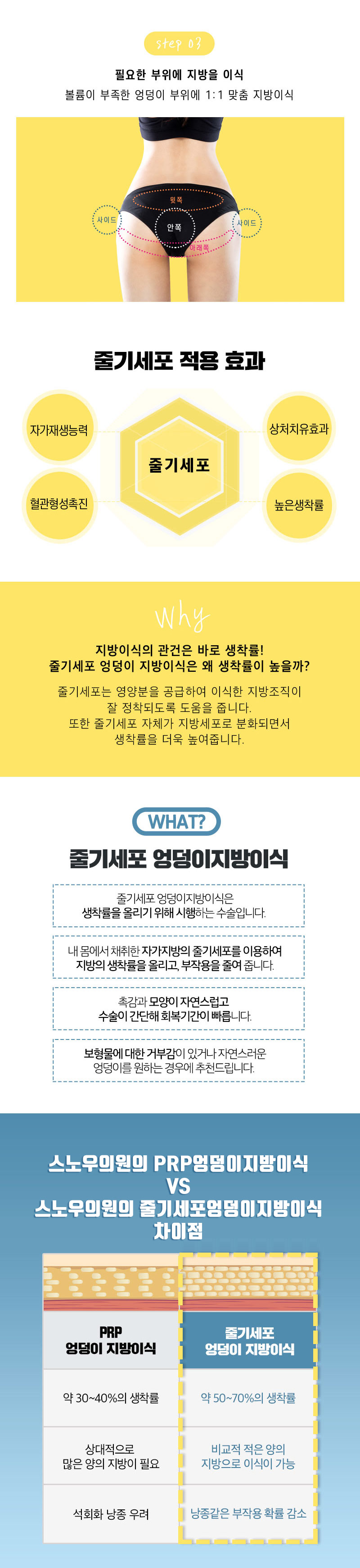 스노우의원 줄기세포 힙업 엉덩이지방이식 이벤트, 시술 상세 이미지