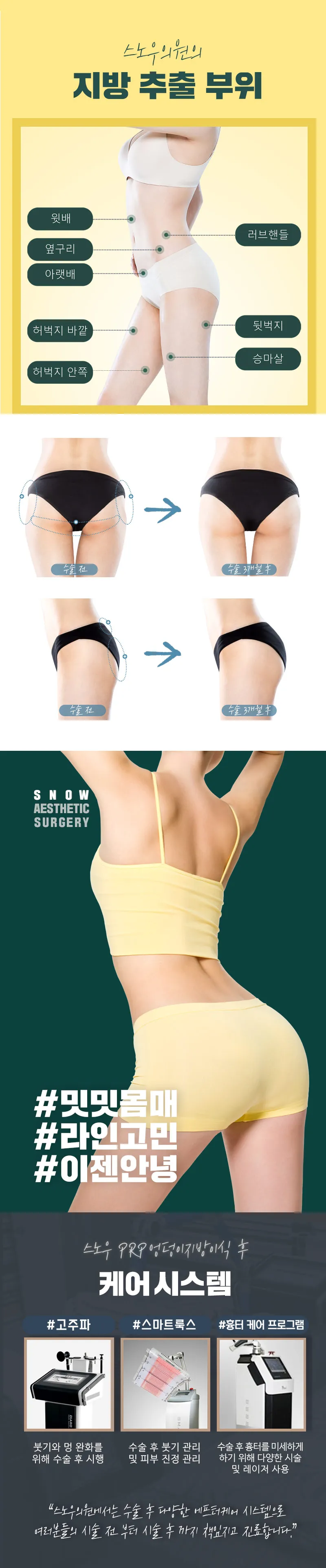 스노우의원 힙업 PRR 엉덩이지방이식 이벤트, 시술 상세 이미지