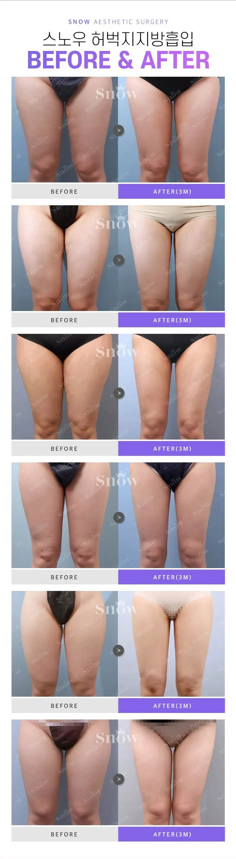 스노우의원 대용량 허벅지 지방흡입 이벤트, 시술 상세 이미지