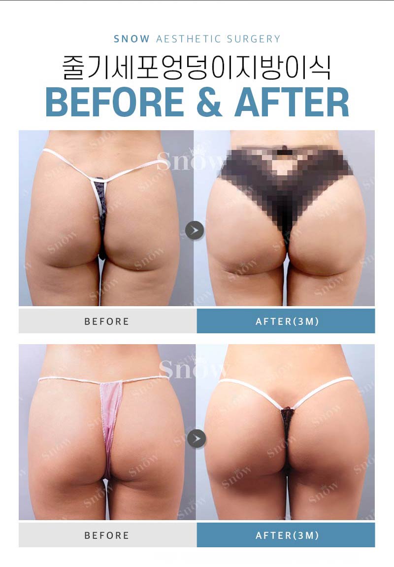 스노우의원 줄기세포 힙업 엉덩이지방이식 이벤트, 시술 상세 이미지