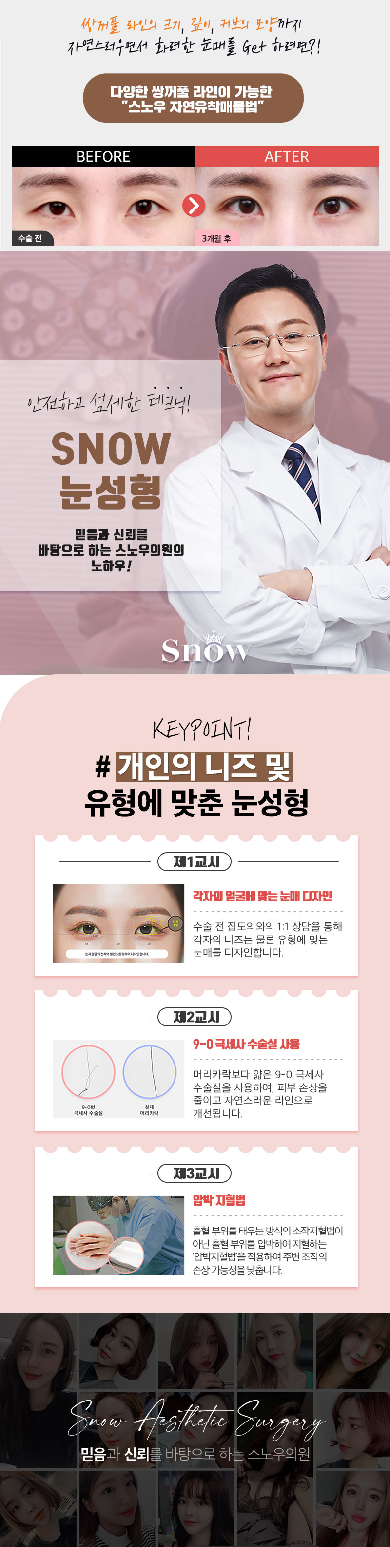 스노우의원 수험생 자연유착쌍수 이벤트 이벤트, 시술 상세 이미지