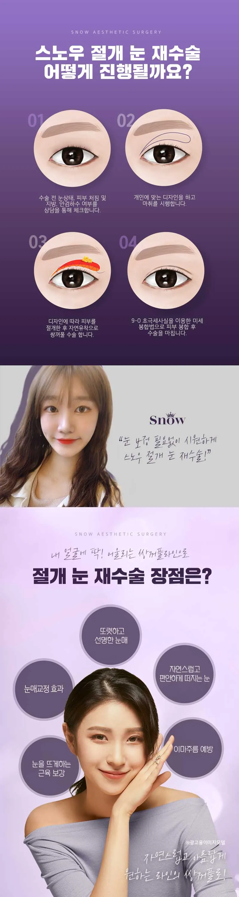 스노우의원 비밀눈성형 절개 눈재수술 이벤트, 시술 상세 이미지