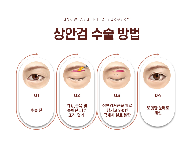 스노우의원 중년눈성형 상안검 눈썹하거상 이벤트, 시술 상세 이미지