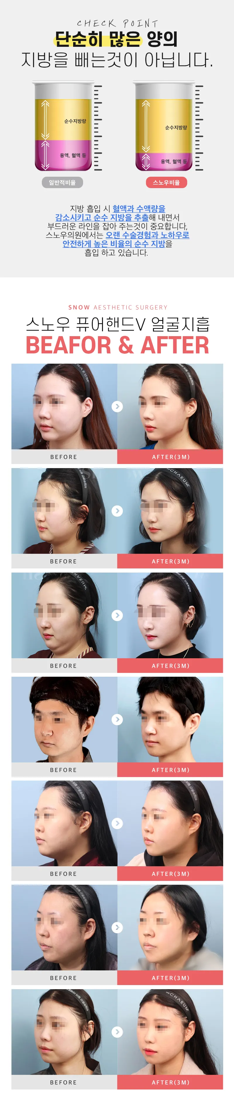 스노우의원 대용량 얼굴지방흡입 이벤트, 시술 상세 이미지
