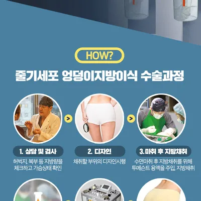스노우의원 줄기세포 힙업 엉덩이지방이식 이벤트, 시술 상세 이미지