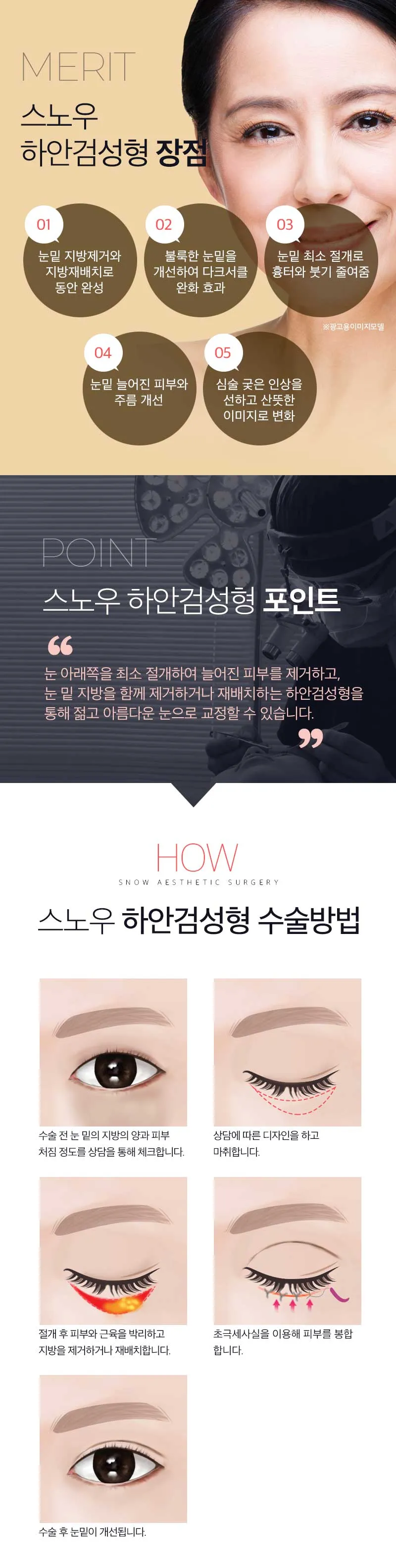 스노우의원 중년 눈성형 하안검 이벤트, 시술 상세 이미지