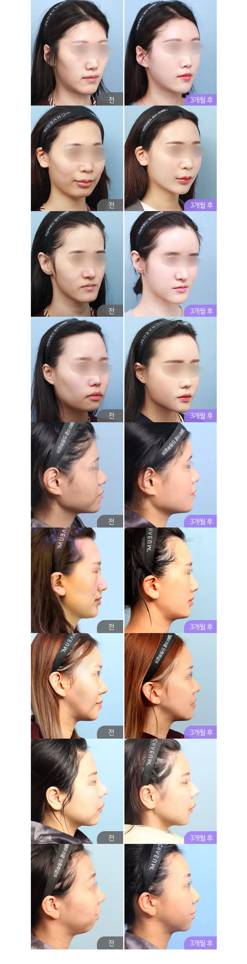 스노우의원 PRP 얼굴지방이식 이벤트, 시술 상세 이미지
