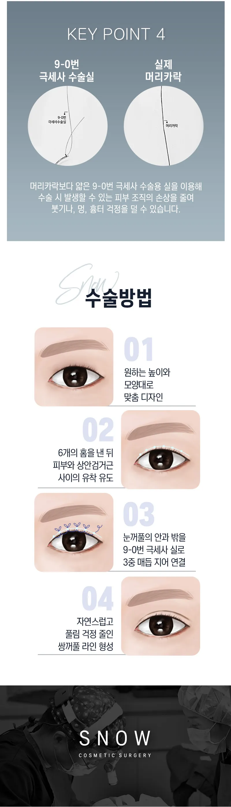 스노우의원 비밀눈성형 매몰재수술 이벤트, 시술 상세 이미지