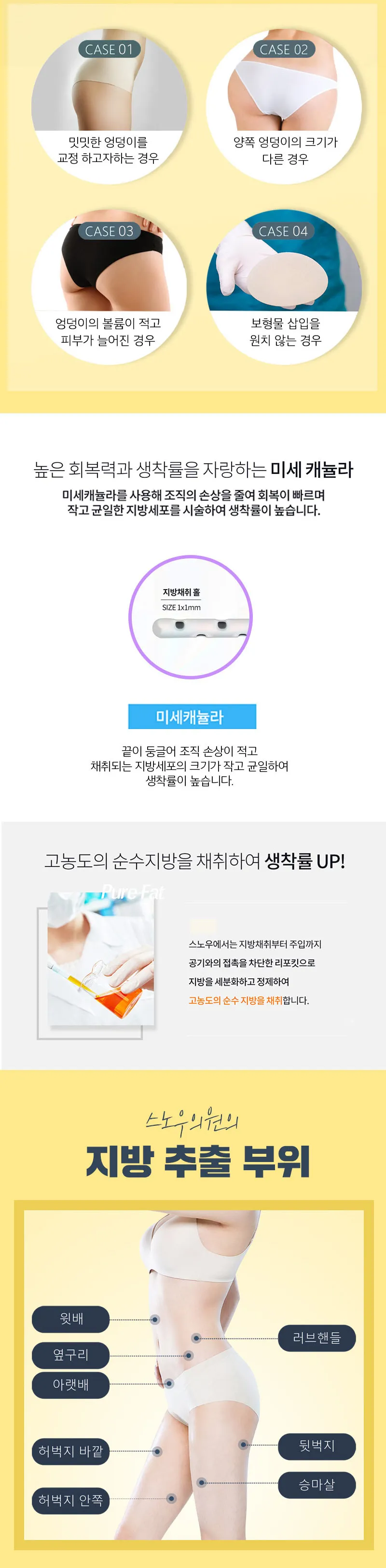 스노우의원 줄기세포 힙업 엉덩이지방이식 이벤트, 시술 상세 이미지