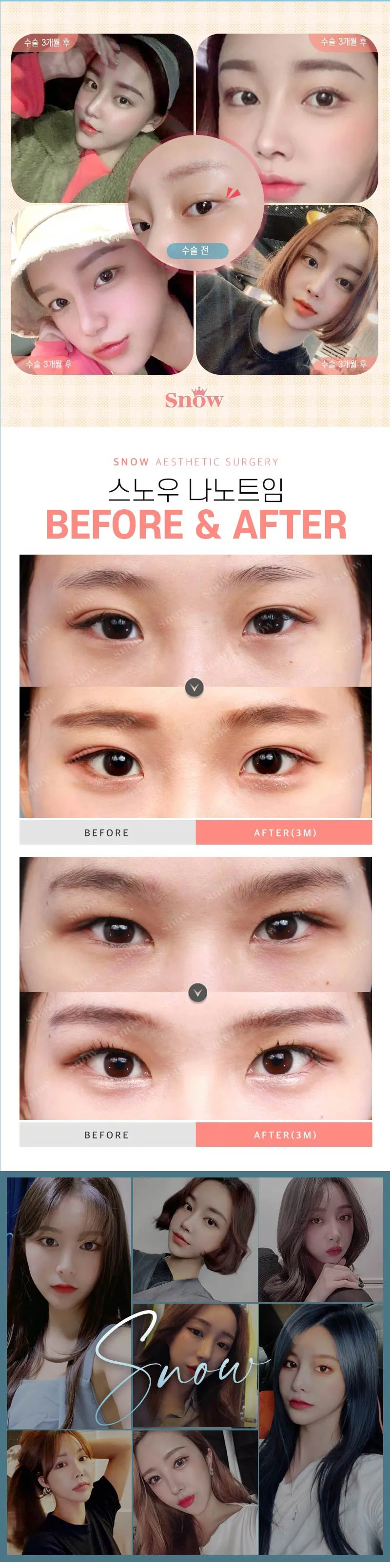 스노우의원 블링블링 나노트임 이벤트, 시술 상세 이미지