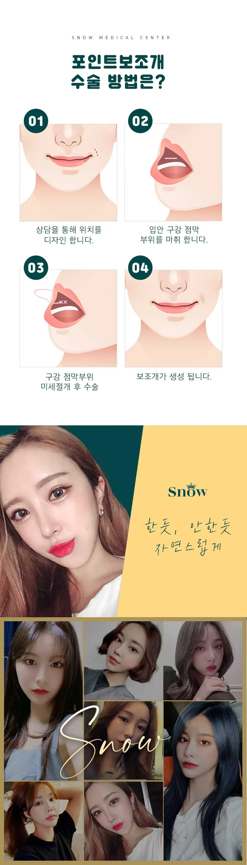 스노우의원 비절개 포인트 보조개 이벤트, 시술 상세 이미지