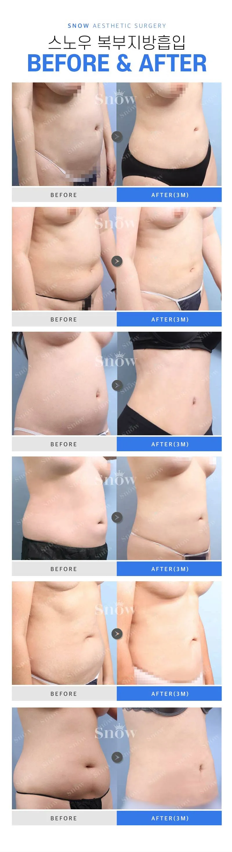 스노우의원 대용량 복부 지방흡입 이벤트, 시술 상세 이미지