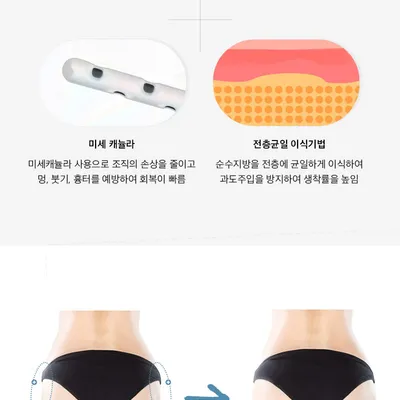 스노우의원 줄기세포 힙업 엉덩이지방이식 이벤트, 시술 상세 이미지