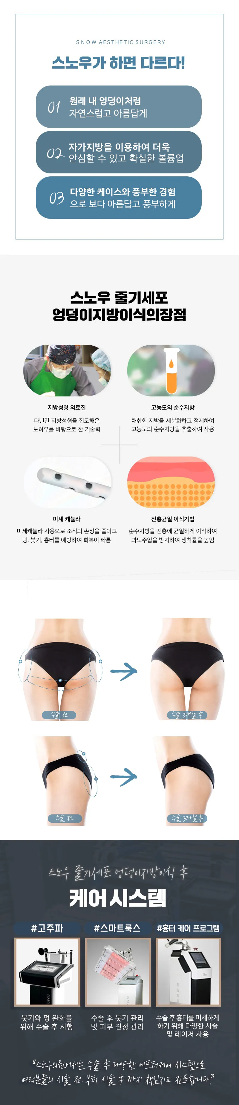 스노우의원 줄기세포 힙업 엉덩이지방이식 이벤트, 시술 상세 이미지